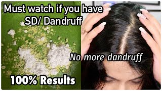 Current Scalp & Hair Situation | BEST SEBORRHEIC DERMATITIS TREATMENT |Best Home Remedy for Dandruff