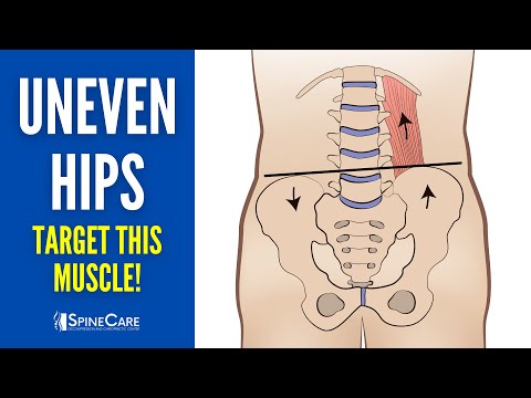 How To Fix Uneven Hips Chiropractor