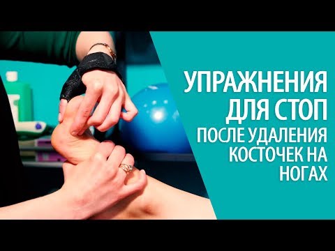 УПРАЖНЕНИЯ ДЛЯ СТОП после удаления косточек на ногах HALLUX VALGUS Алексей Олейник