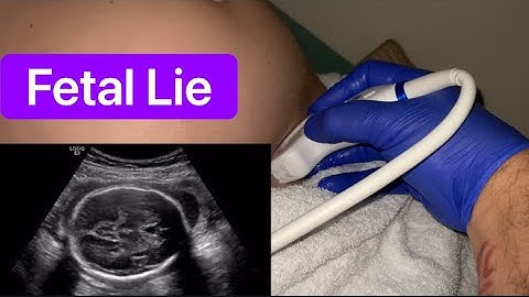 Fetal Lie