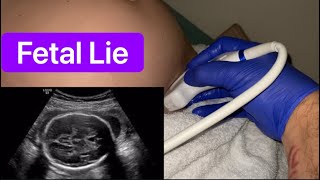 Celebrity Fetal Lie Wealth