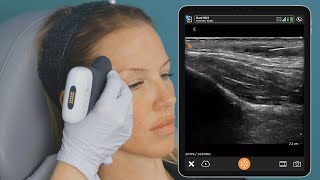 Ultrasound Guided Temple Injection Right Side