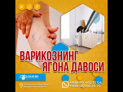 Варикознинг ҳақиқий давоси.