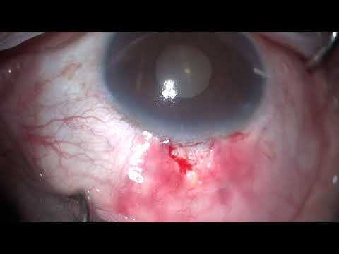 Vídeo: Resultados De Segurança E Eficácia Do Uso Do Xen45 Gel Stent No Glaucoma Refratário: Uma Série De Cirurgias De Cirurgiões Estagiários Em Um Hospital De Ensino Terciário