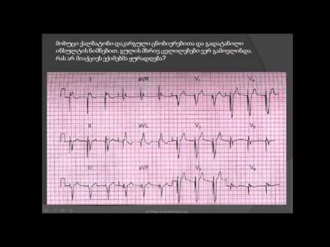 კარდიოსტიმულატორი. მოციმციმე არითმია . თრომბოემბოლია. kardiostimulatori (mocimcime aritmia)