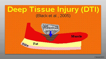 Prof. Amit Gefen explaining pressure ulcer research (part 1 of 2)