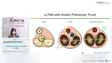 Conduction system anatomy in CHD