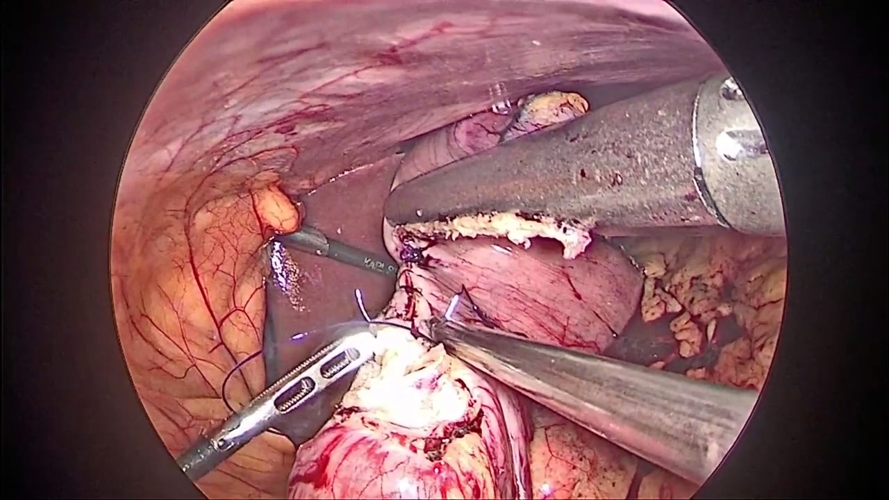 carencia stucked stapler