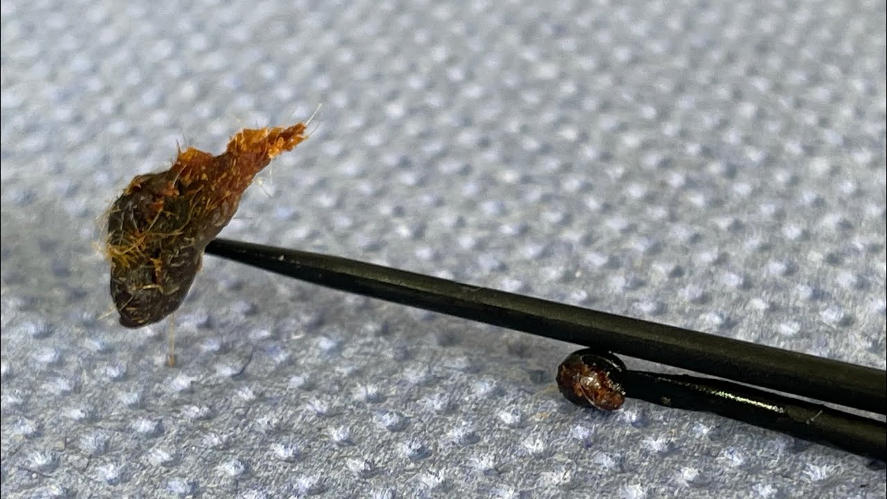 Ear Wax Removal 103 The Mansfield Wax Clinic YouTube