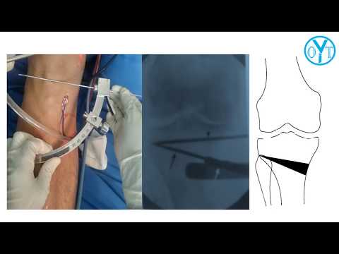 Vídeo: O Efeito Da Osteotomia Tibial Alta De Cunha Aberta Medial Na Articulação Femoropatelar: Análise Comparativa De Acordo Com O Estado De Cartilagem Preexistente