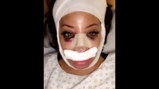 Famous #HazelE nose job news! Plastic Surgery! Love and Hip Hop Hollywood Season 2! #LHHHOLLYWOOD #LHHH Wealth