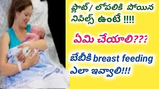 Breast Feeding Problemsafter Delivery Feeding Techniques