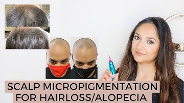 Scalp Micropigmentation for Hairloss or Alopecia
