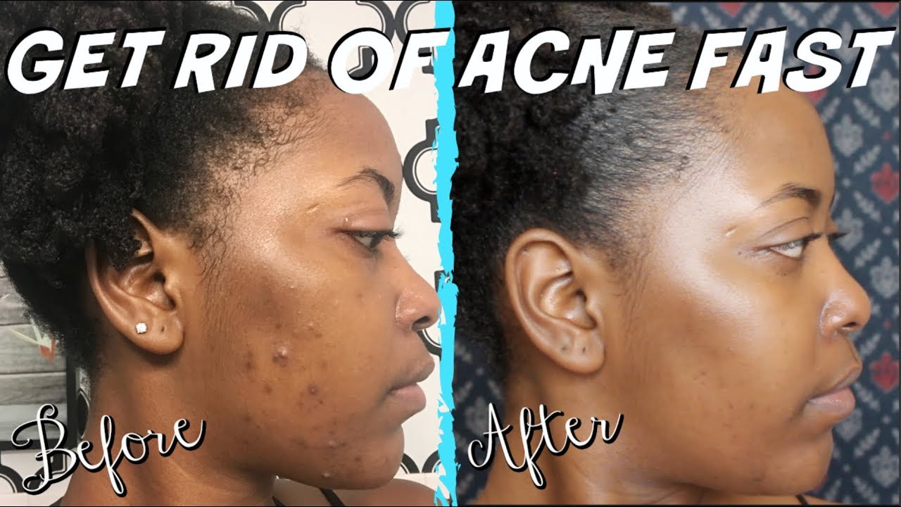 SKIN CARE ROUTINE FOR ACNE & DARK SPOTS (kandidkinks) YouTube