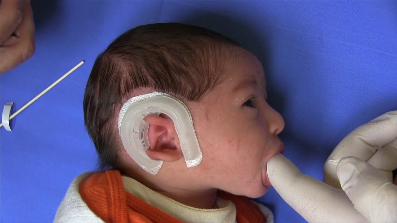 Cup Ear Infant Ear Deformity Corrected with EarWell® Infant Ear