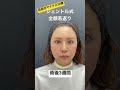 50歳☞30代に⁉️ 眉下リフト、クマ取り、脂肪注入、糸リフトの全顔若返り整形。