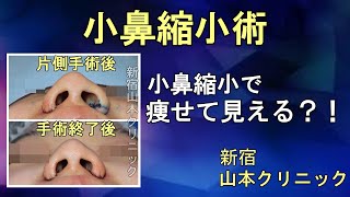 小鼻縮小術で痩せて見える？？@山本クリニック