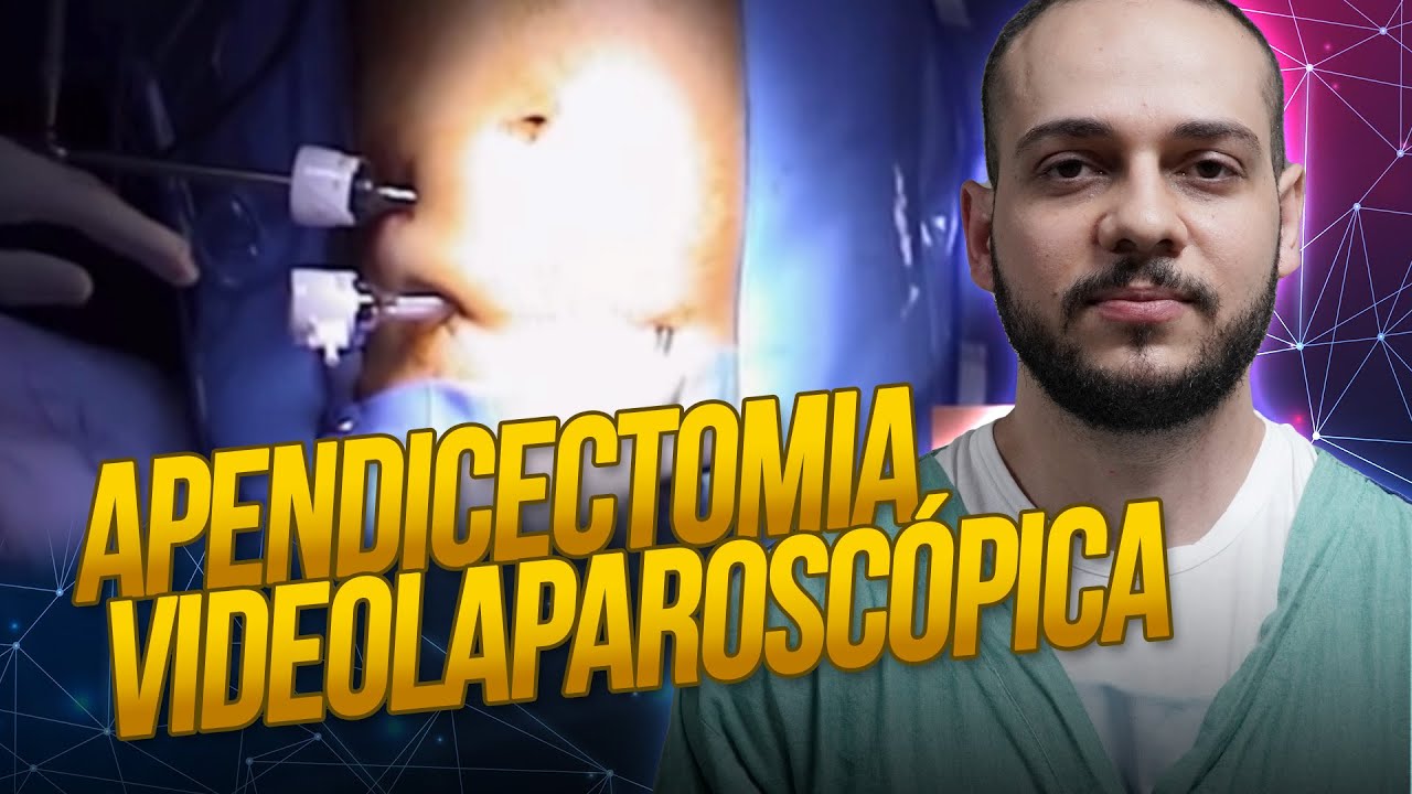 Cirurgia de apendicite por videolaparoscopia: Dr. Thiago analisa passo ...