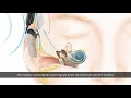 How nucleus cochlear implant works - N6