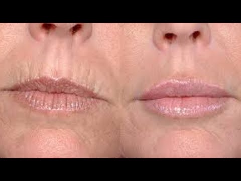Βίντεο: 3 τρόποι για να θεραπεύσετε τις ρωγμές στις γωνίες του στόματος σας