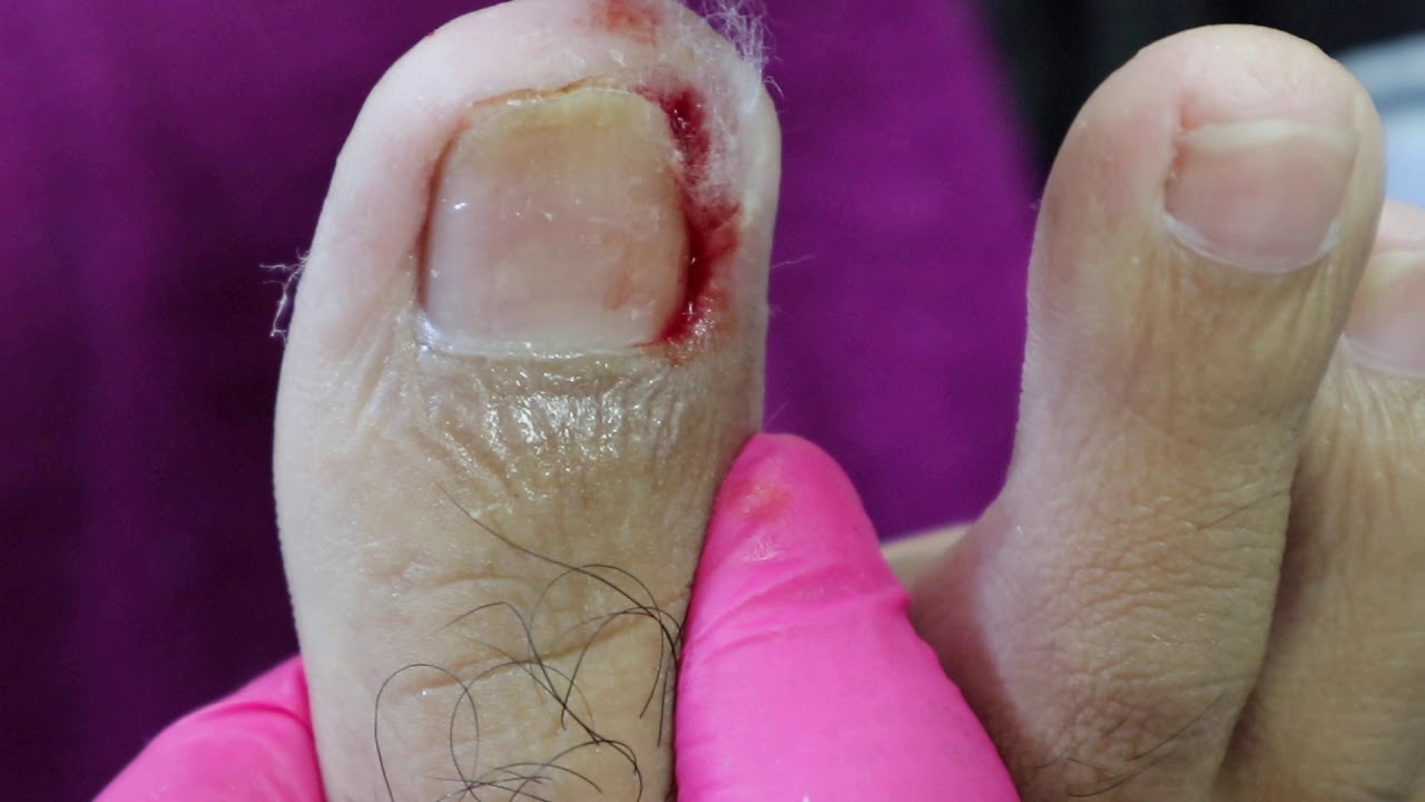 Ep_611 Ingrown nail removal 👣 เนื้อปูดเกิดขึ้นได้อย่างไร? (This clip