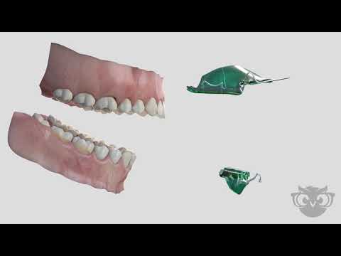 Orthodontic Appliances Explained