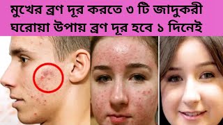 pimple remove 100 % | মুখের ব্রণ দূর করার উপায় | তৈলাক্ত ত্বকের ব্রণ ও ব্রণের দাগ দূর করার উপায় | screenshot 4