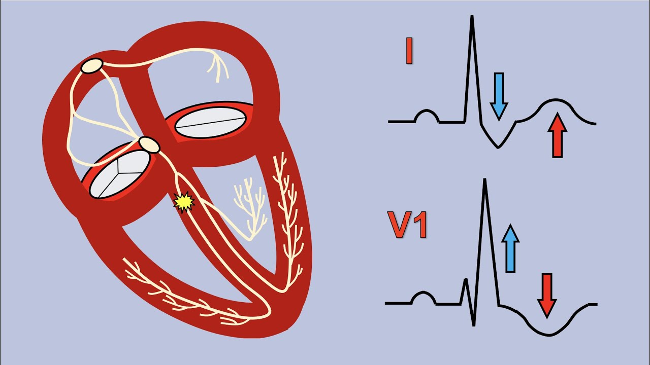 Right Bundle Branch Block And Bifascicular Block