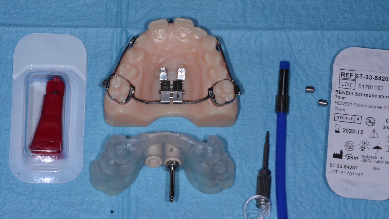 POSITIONING OF PALATAL MINIIMPLANT FOR A MAXILLARY EXPANDER IN A SINGLE APPOINTMENT YouTube