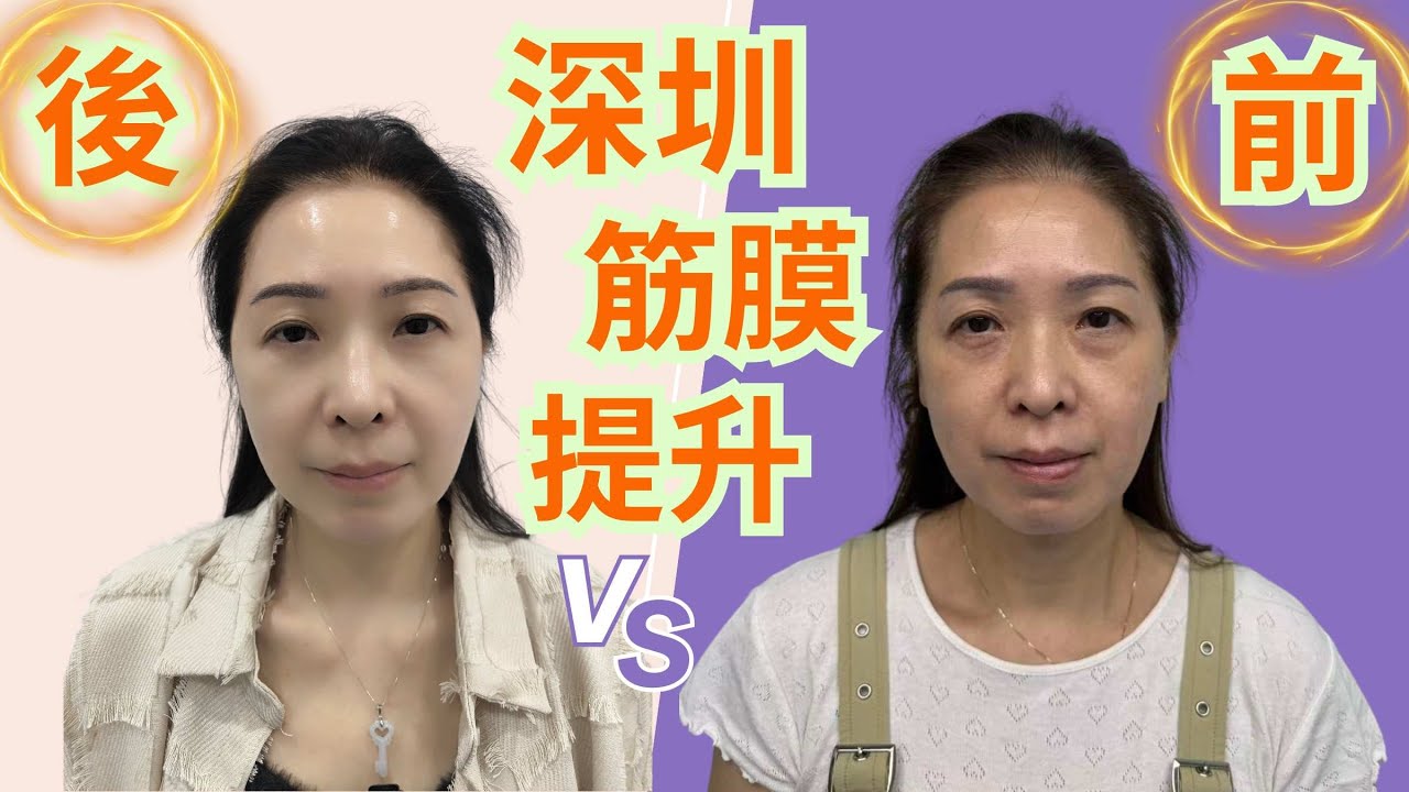 祖哥太太,親身上深圳做(筋膜提升)😱😱拍攝全過程👍手術前後對比👍提醒大家一定要睇尾段視頻❤️❤️