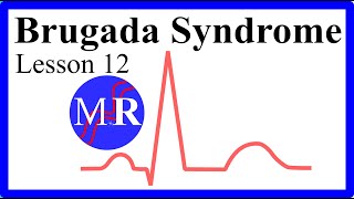 Brugada Syndrome