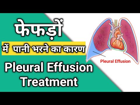 how to treat pleural effusion | फेफड़ों में पानी भरने का कारण | pleural effusion treatment