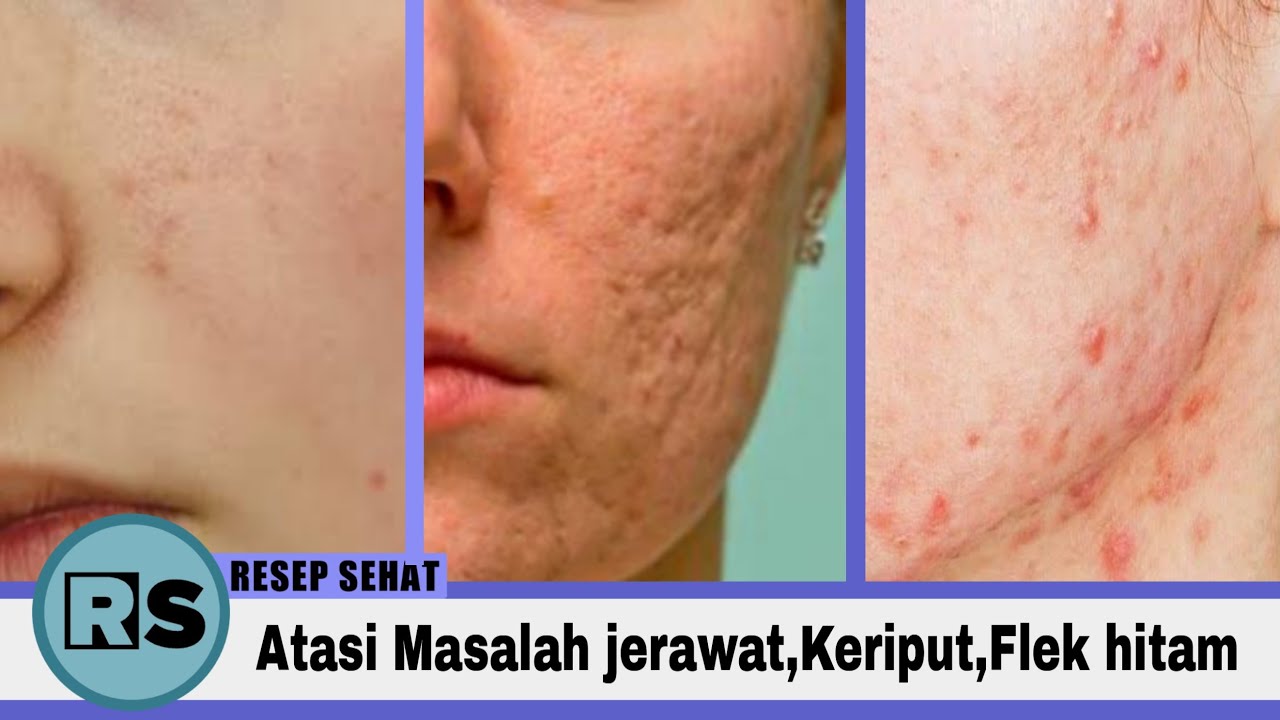 AMPUH | Cara menghilangkan jerawat,keriput,flek hitam | Cara
