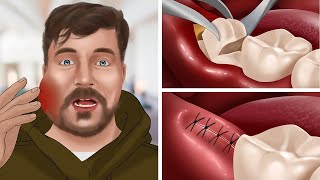 [ASMR Animation] Wisdom teeth treatment for MrBeast | WOW Brain Dental care screenshot 1