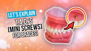 What are TADs (Miniscrews) with Braces... & Will You Need One?