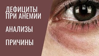 ВИДЫ Анемий. 1. ДЕФИЦИТНЫЕ (на железо, медь, вит В1, В9, В12, вит Е)