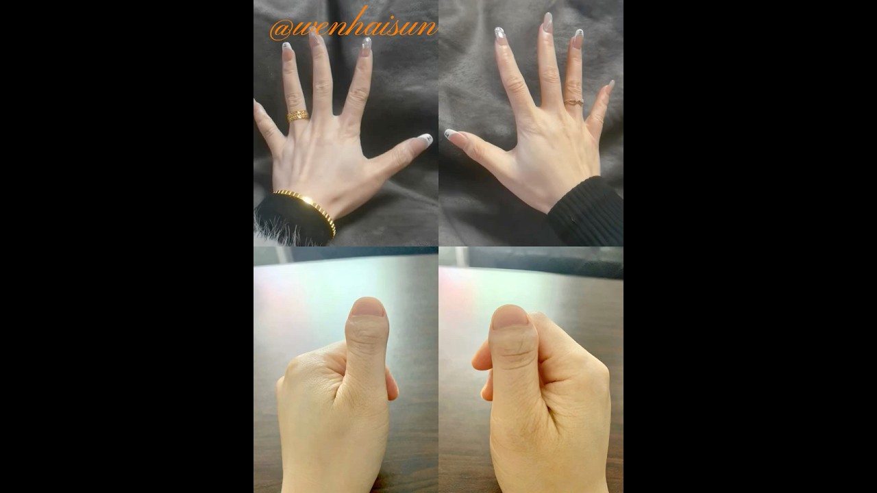 Brachydactyly type D.  toethumbs, clubbed thumbs, stubby thumbs 