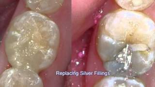 Replacing Silver Fillings 4-5