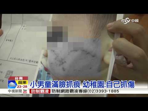 【中視新聞】小男童滿臉抓痕 幼稚園:自己抓傷20150908
