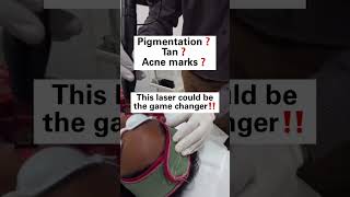 This laser could be the game changer ✨