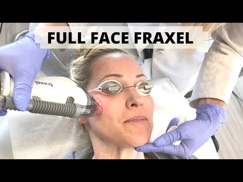 FRAXEL LASER TREATMENT WITH DR. STEFANI KAPPEL | FULL FACE BEFORE & AFTER | EP031
