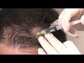 Dermaheal hl   hair regrowth