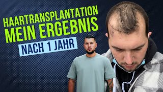 Haartransplantation Vorher Nachher - 12 Monate nach der OP