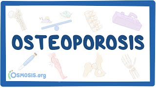 Osteoporoza - przyczyny, objawy, rozpoznanie, leczenie, patologia