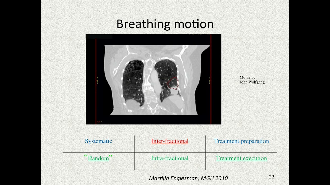 motion management ( radiotherapy ) - YouTube