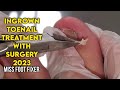 QUICK TREATMENT : INGROWN TOENAIL TREATMENT SURGERY BY FAMOUS PODIATRIST MISS FOOT FIXER