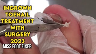 QUICK TREATMENT : INGROWN TOENAIL TREATMENT SURGERY BY FAMOUS PODIATRIST MISS FOOT FIXER