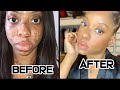HOW TO CLEAR ACNE AND DARK SPOTS | MY MORNING ROUTINE | AFRICAN BLACK SOAP