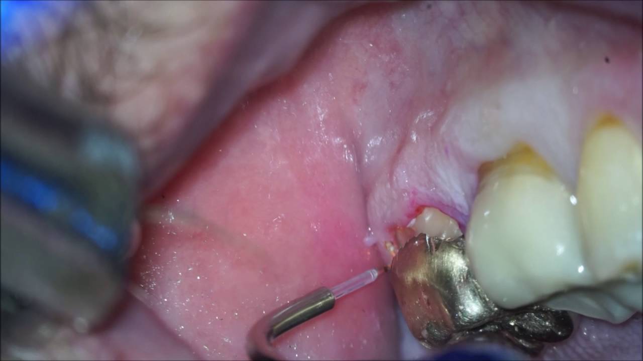 18 buccal amalgam patch with narration YouTube