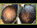 RECUPERA su CABELLO en 5 MESES SIN TRASPLANTE CAPILAR